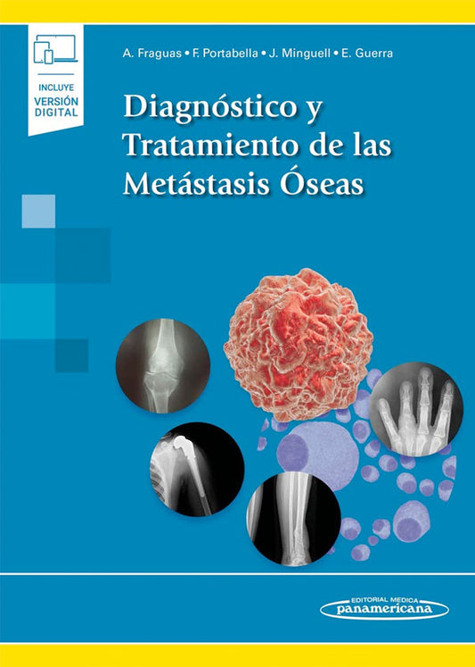 Diagnóstico y tratamiento de las metástasis óseas