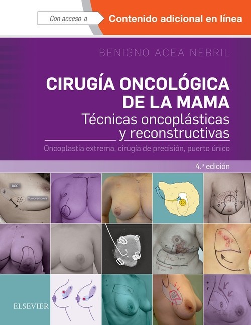 Cirugía oncoógica de la mama. Técnicas oncoplásticas y reconstructivas