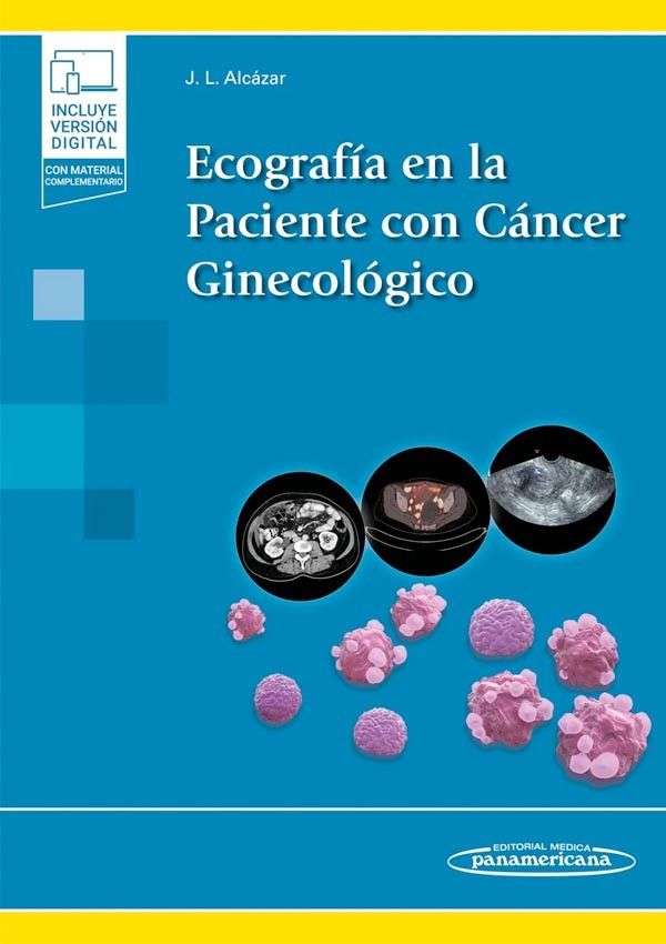 Ecografía en la paciente con cáncer ginecológico