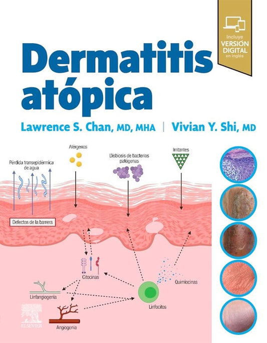 Dermatitis atópica